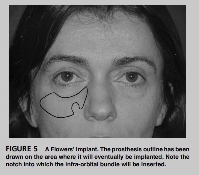 印第安纹解剖学,印第安纹分型对策