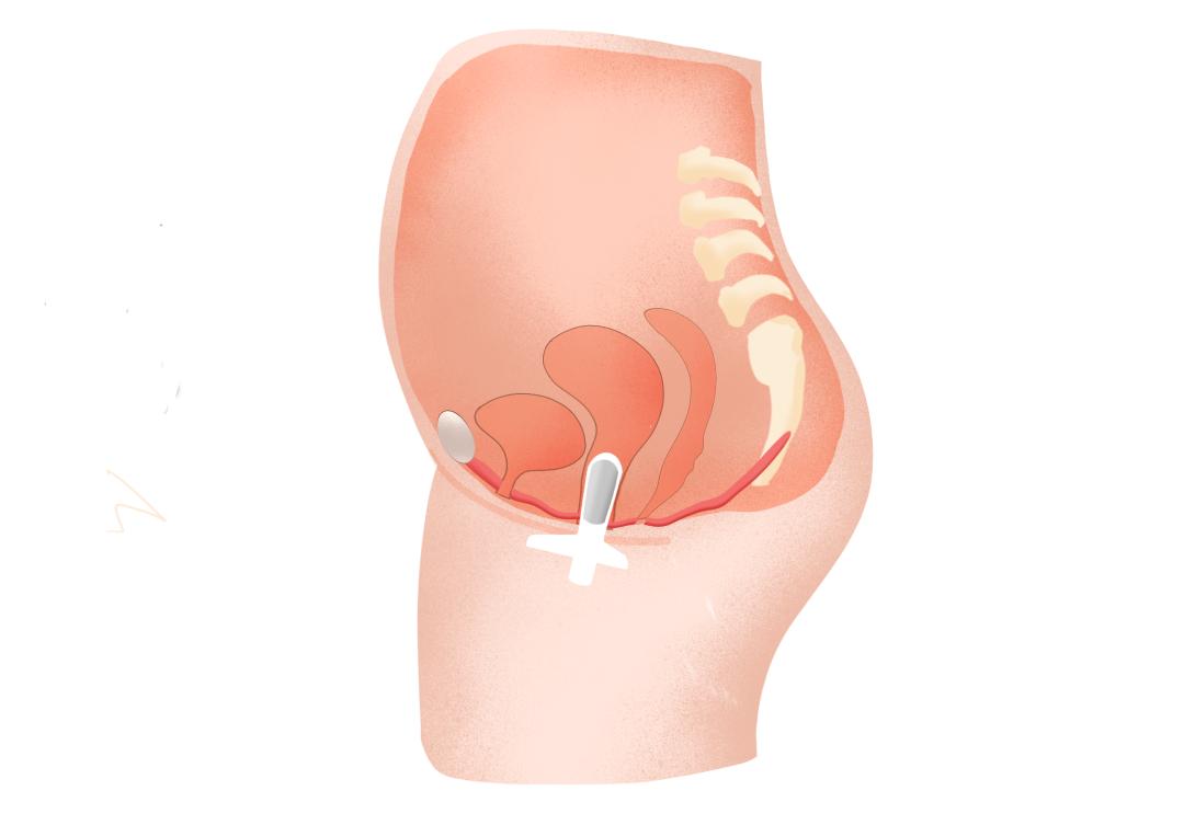 大笑就漏尿做盆底康复治疗能好吗,产后漏尿需要做几次盆底康复