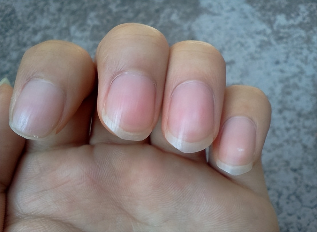 指甲竖纹与肝脏的关系,指甲盖有竖纹凸起是肝有病吗