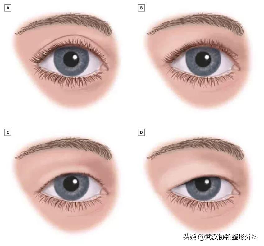 提眉术加开眼角,泡泡眼提眉术