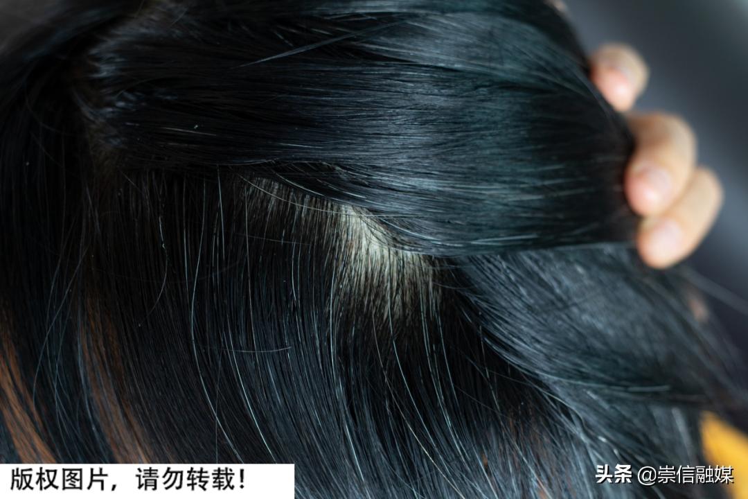 白发自然变少了是什么原因,两鬓角有白发是缺什么营养