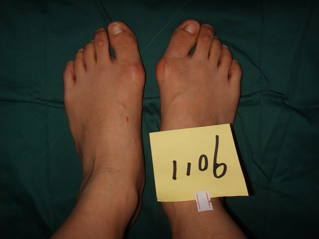 轻度的拇外翻医院有治疗的方法吗,轻度拇外翻需要治疗吗