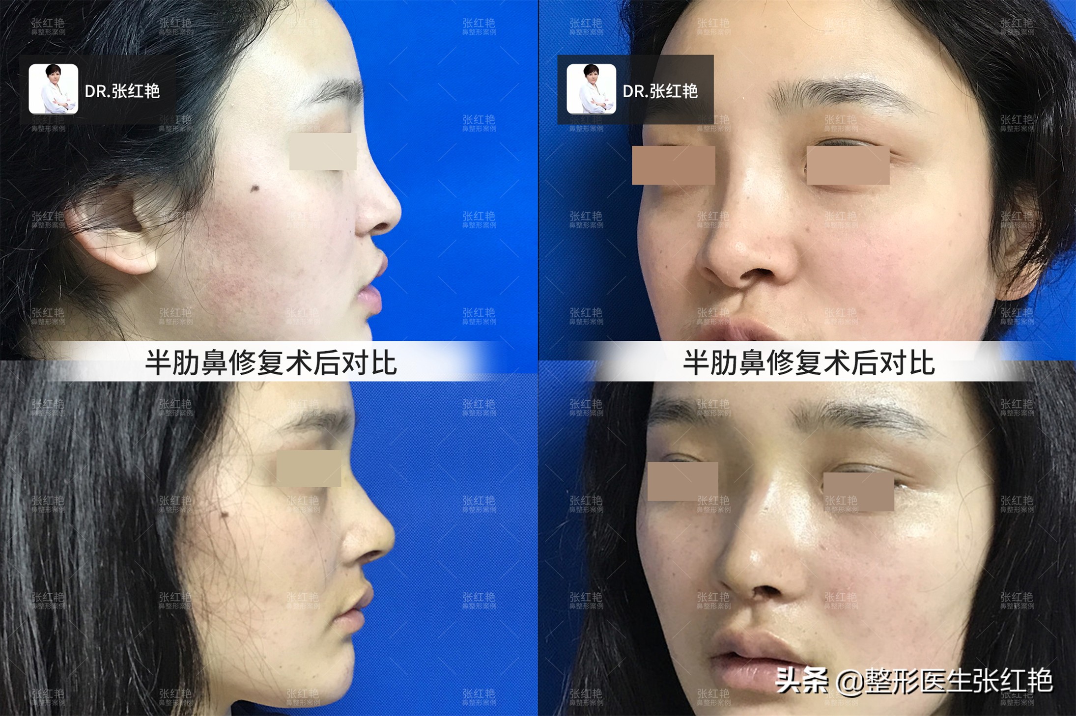 鼻子整形前后真实案例,鼻整形术中的鼻孔之美