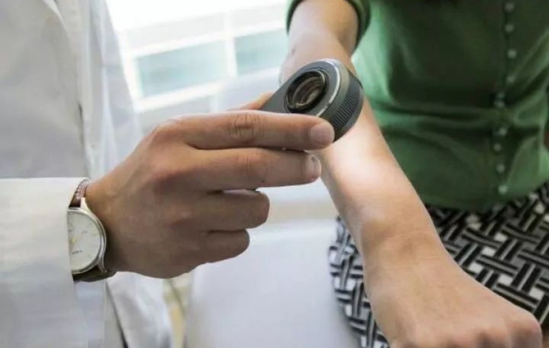 女子身上长虫医生拿镊子治疗,女子体内有蜱虫被医生拿镊子拔出