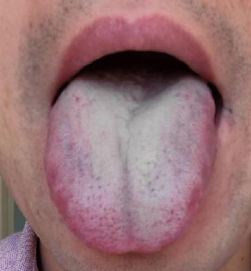 3个中成药精准去湿热，不做油腻中年人