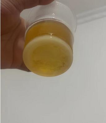 前列腺特殊治疗多效应治疗收费,跑步治疗慢性前列腺炎案例