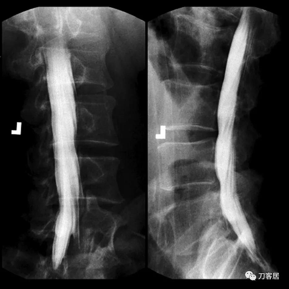 腰麻意外注射氨茶碱后患者截瘫，2年后死亡