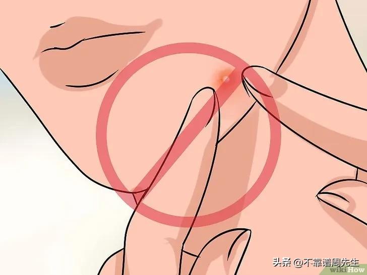 祛痘淡斑痘印怎么去除小妙招,长痘痘留下的黑色痘印怎么消除