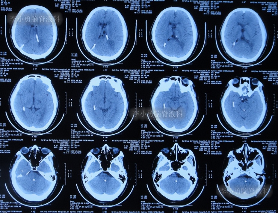 脑积水三脑室造瘘多久能恢复,脑囊虫手术后脑积水