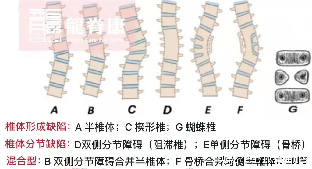 什么是先天性脊柱侧弯,先天性脊柱侧弯手术费用报销吗