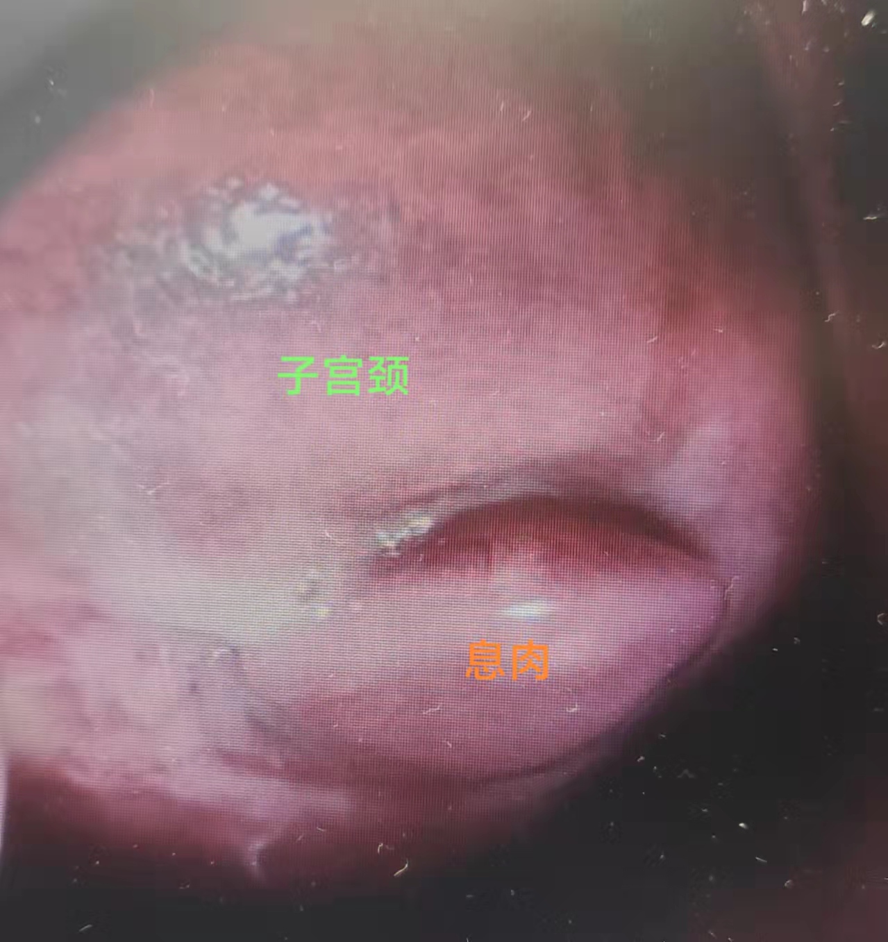 不同部位的多发息肉如何取病理,身上多处长息肉是怎么回事