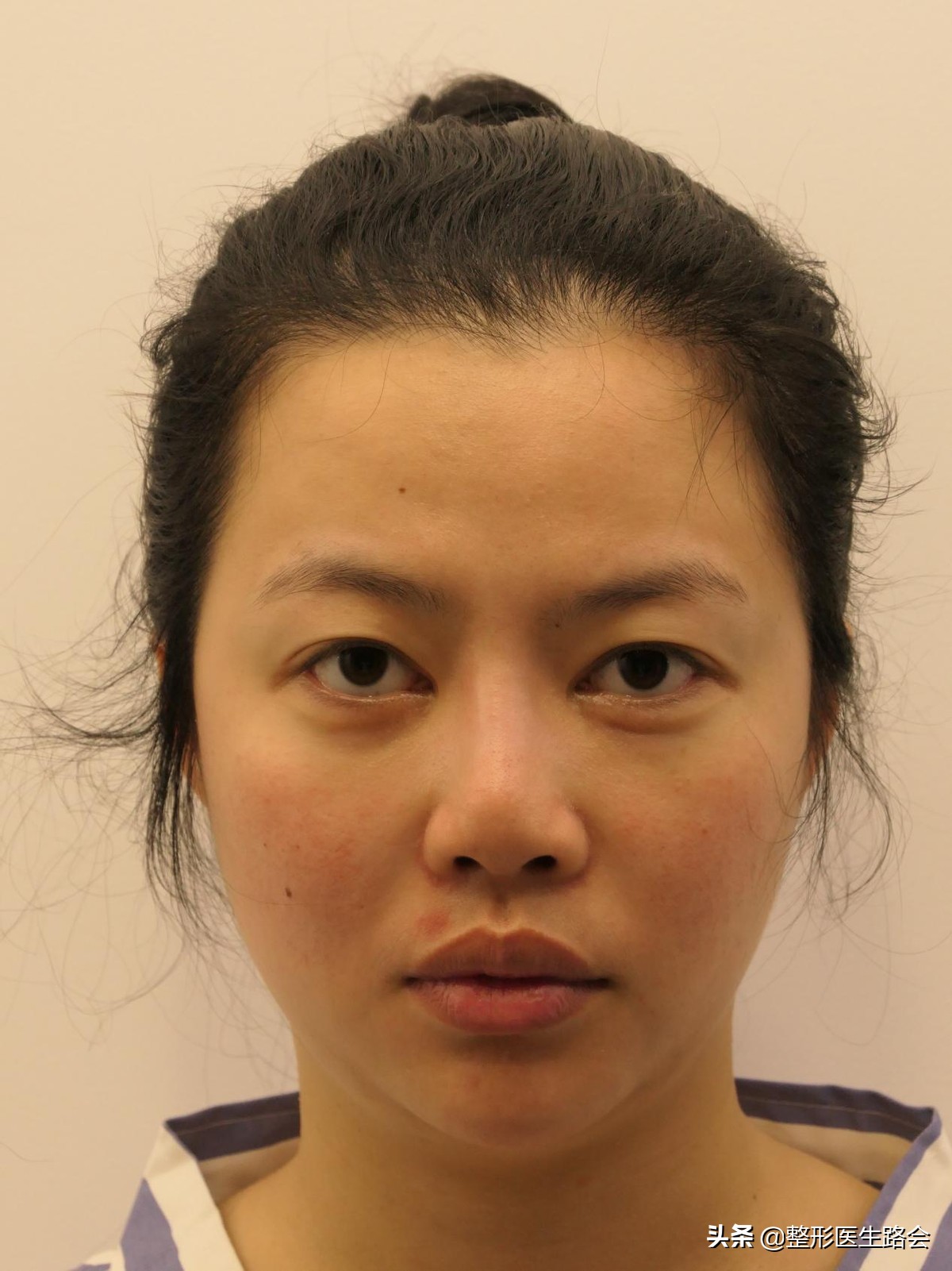 隆鼻失败鼻头有个坑的原因,隆鼻失败导致的鼻头凹陷怎么修复