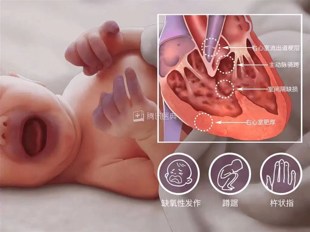 *藏西**娃一哭就嘴唇变紫！妈妈冒死来深“锯胸剖心”