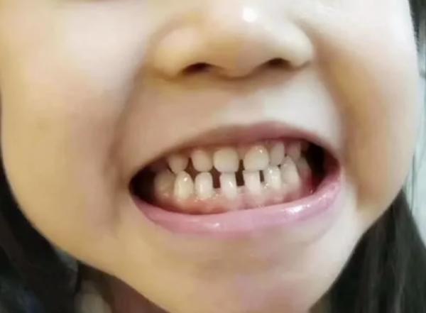 孩子上牙的牙缝特别宽要矫正吗,宝宝牙缝大换了牙齿会不会改善