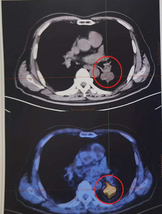 PET/CT病例（6）：4.0cm肺癌治疗后缩小到1cm，来看看治疗方案