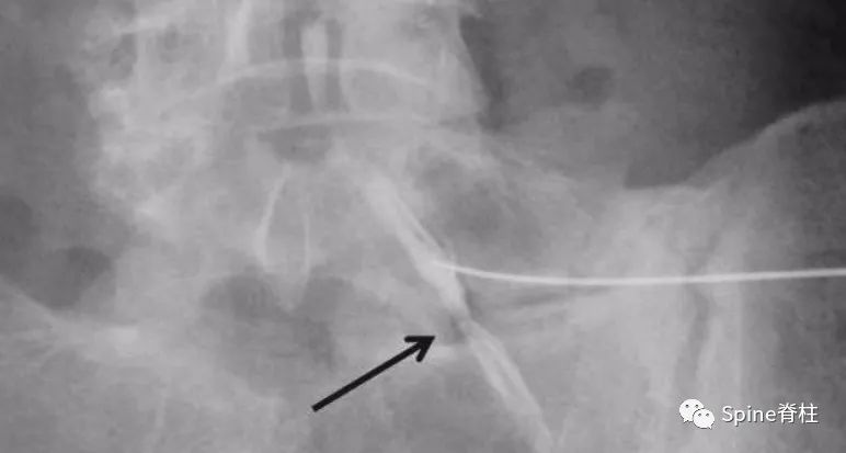 腰椎间盘突出症状表现,腰椎间盘突出症疼痛最佳止痛方法