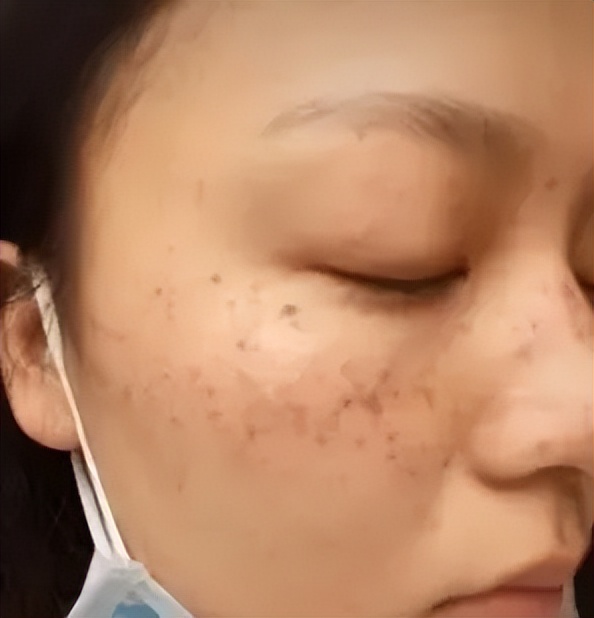 老年斑和色素沉着怎么治,老年人色素沉着怎么去除