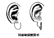 耳垂缺损|耳垂缺了一块还能复原吗？