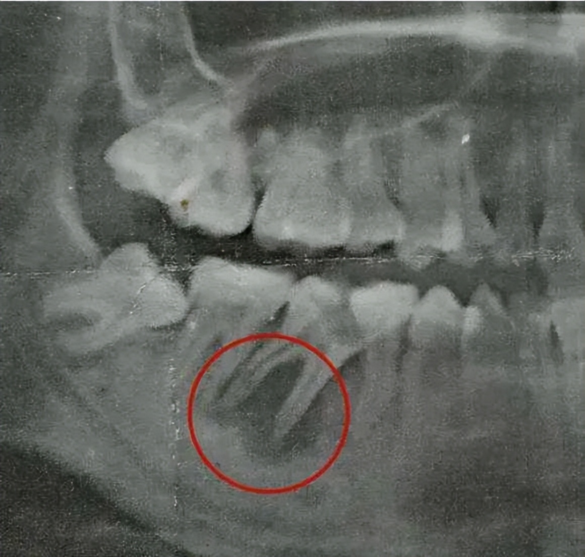 烂牙做根管治疗,烂牙做牙套好吗