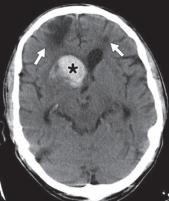 脑水肿的影像,脑水肿形成机制生理学