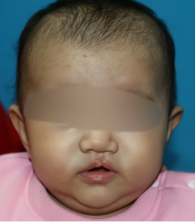 唇隐裂能完全修复吗,唇隐裂痕迹怎么消除