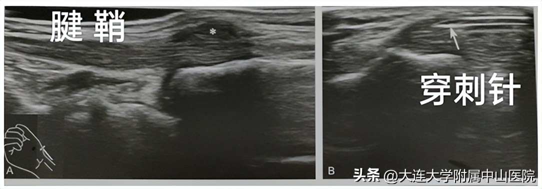 西安肌骨超声精准治疗,门诊超声