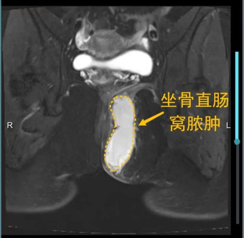 肛周脓肿被医生诊断痔疮,中医治疗肛门脓肿痔疮
