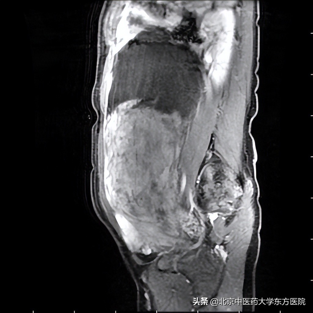 怀孕肚子里为啥长肌瘤,肚子大的像怀孕是不是有肌瘤