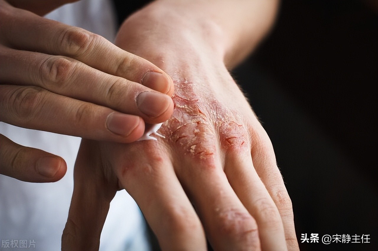 皮肤干燥痒怎么办有哪些小妙招,皮肤干燥痒最好的解决方法