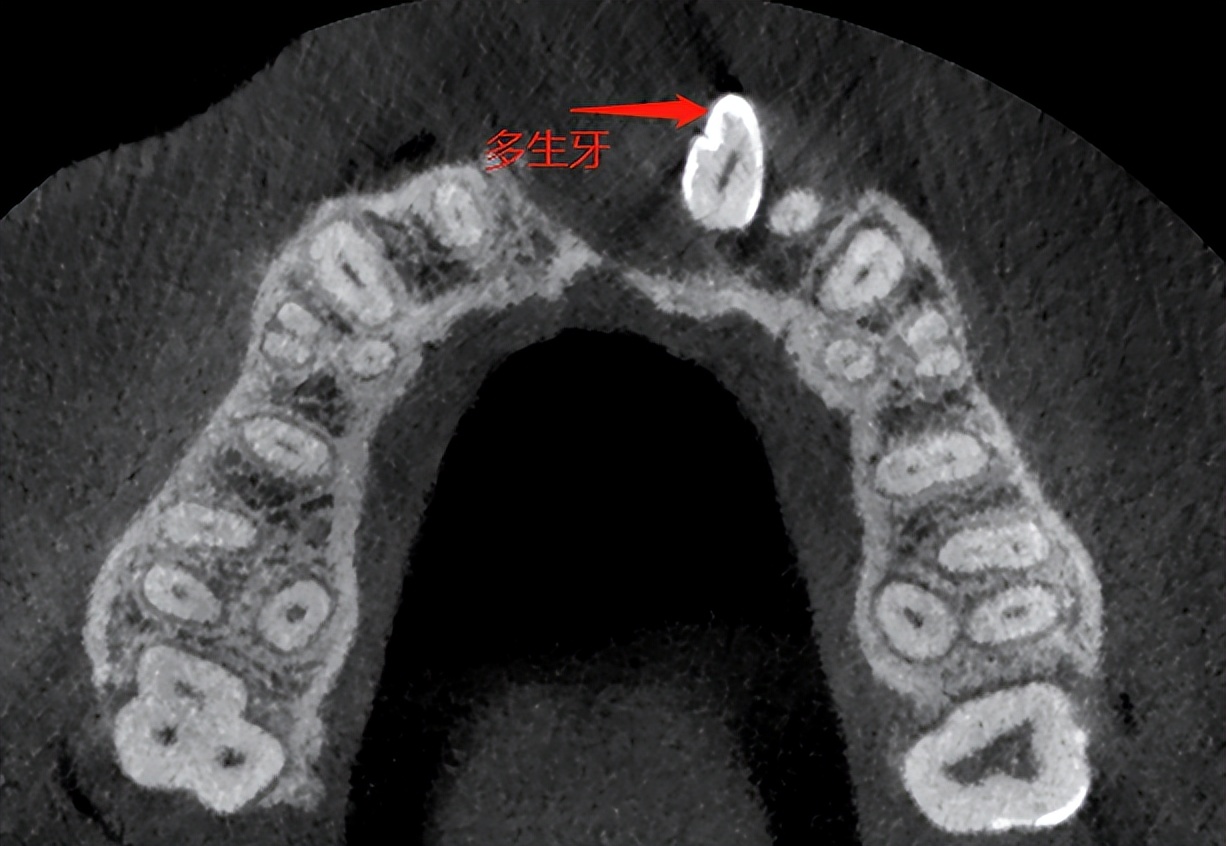 嘴巴有一粒凸起是什么,嘴巴凸起是因为牙齿吗