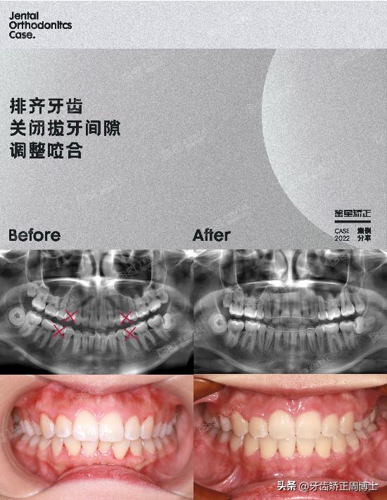 骨性龅牙矫正牙齿变小了,骨性龅牙已经做了正畸手术怎么办