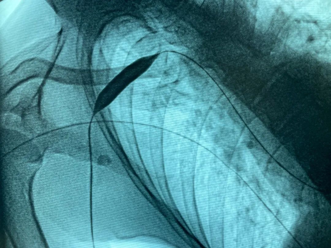 透析患者静脉瓣增生狭窄肾内科血管腔内治疗解决烦恼