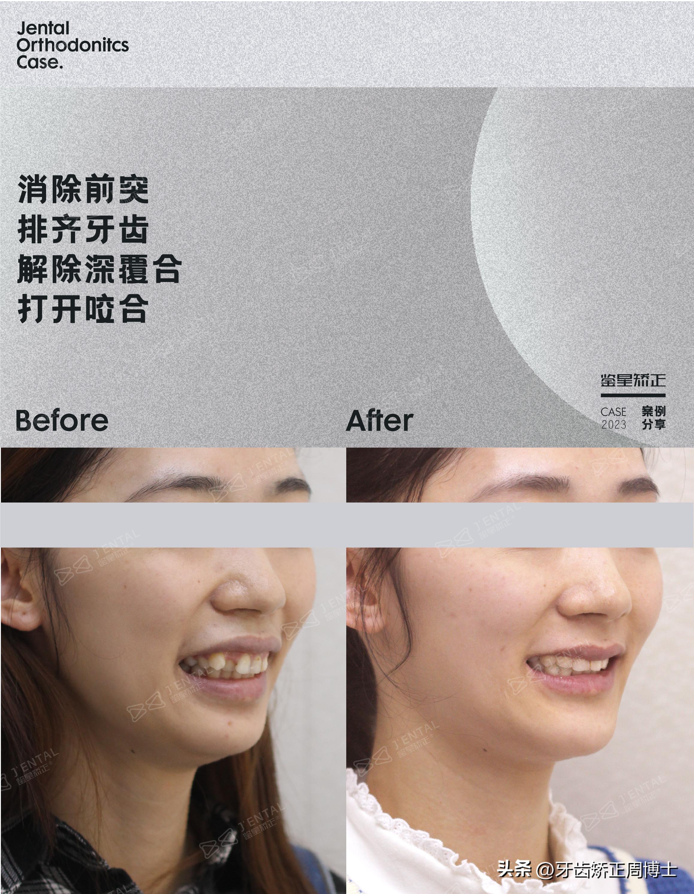 轻度拥挤龅牙咬合错位,龅牙导致牙齿咬合错位矫正价格