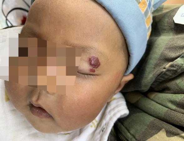 血管瘤要怎样治疗才能消失,血管瘤不治疗有什么坏处