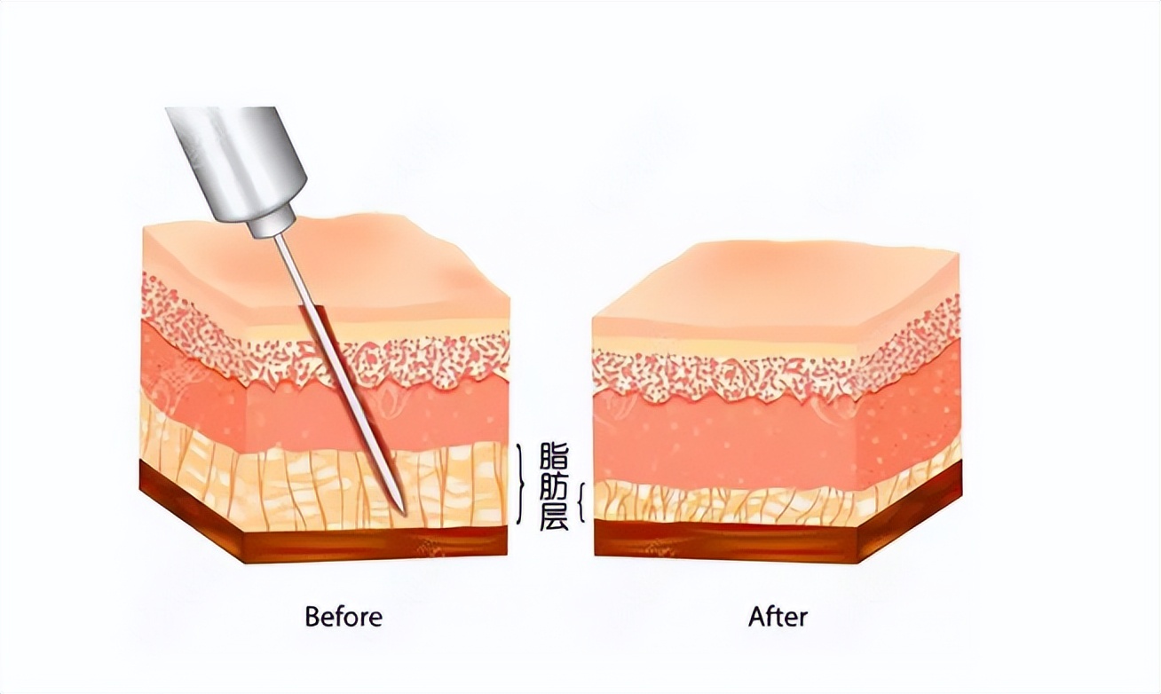 九院韦敏面部吸脂,九院韦敏植骨手术案例
