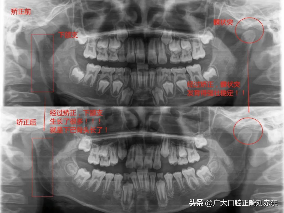 成年以后再矫牙？专家：太迟了，下巴后缩最佳治疗时间是这个时候