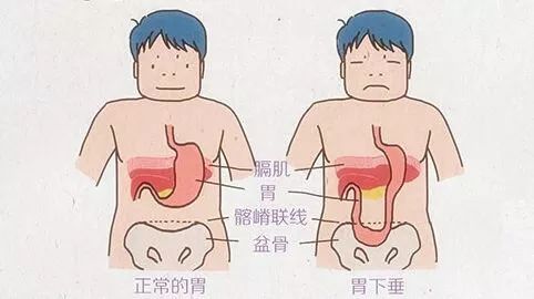 饭后松裤带易致胃下垂,饭后松裤带为啥不好
