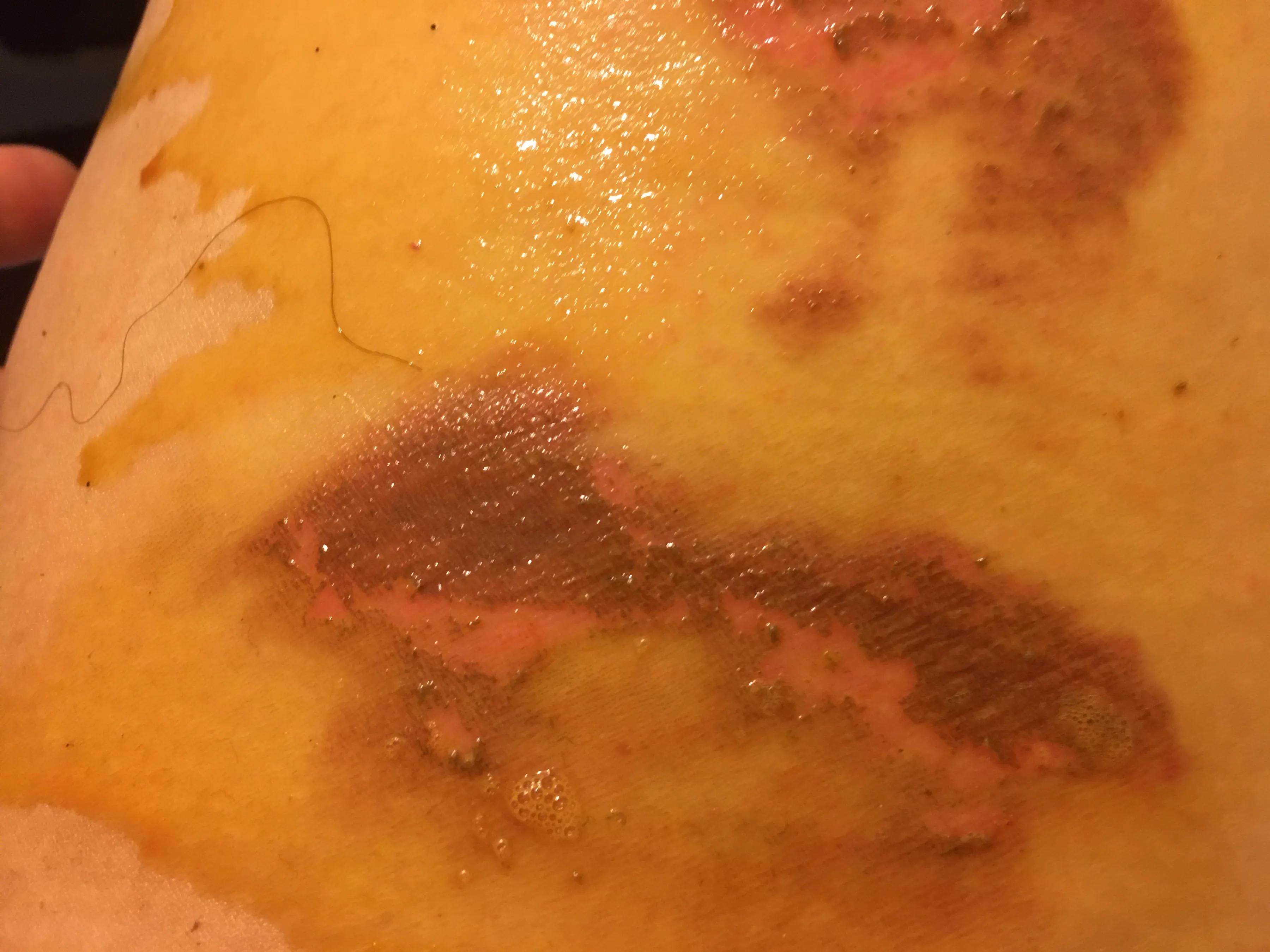 烫伤后的正确处理方法就这五个字,知识分享烫伤后的正确处理方式