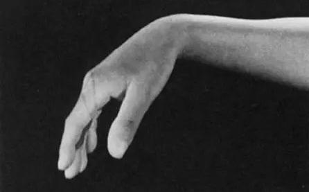 手腕抬不起来什么原因如何治,肱骨骨折手腕抬不起来怎么治