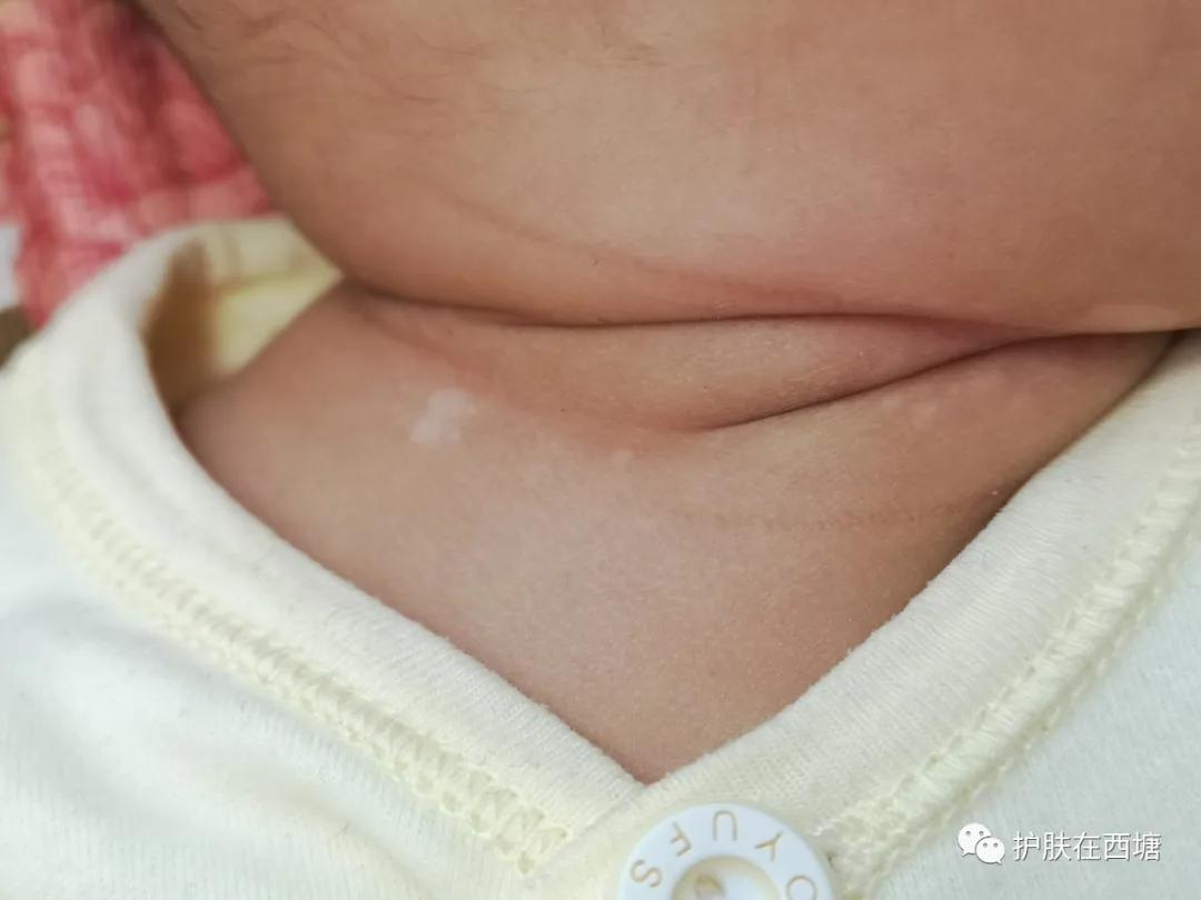 汗斑跟花斑癣,汗斑和花斑糠疹区别