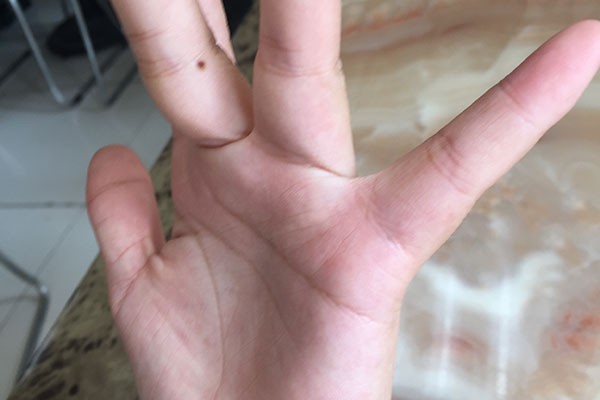 如何鉴别普通痣和黑色素瘤,如何分辨黑痣和黑色素瘤