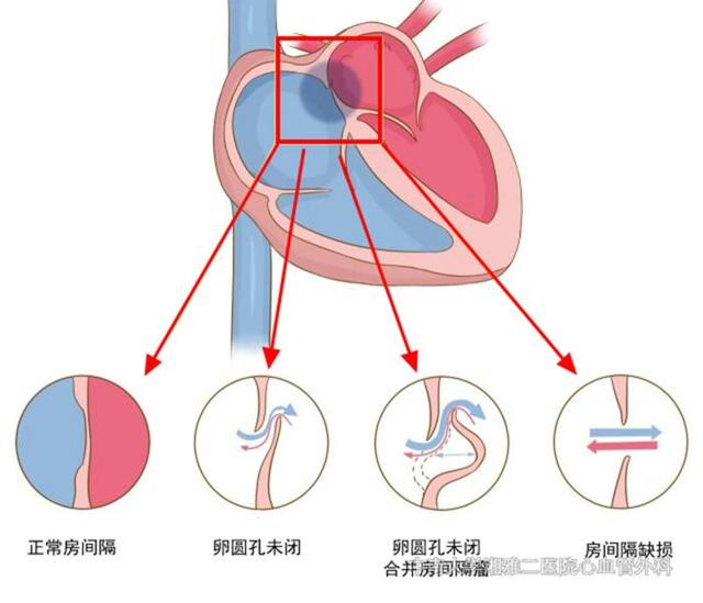 卵圆孔未闭介入封堵治疗前庭性偏头痛的疗效分析