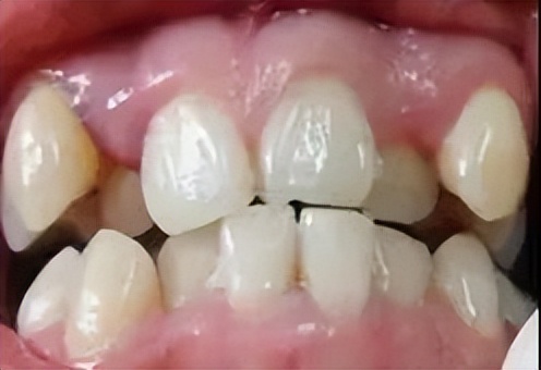 牙齿长小牙该怎么拔掉,牙齿长在上颌窦里了能拔吗