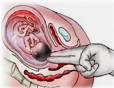 孕妈妈怎么判断胎位是正的,胎儿屁股在右侧是什么胎位