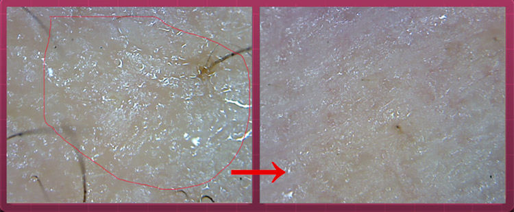 冬季皮肤干燥起皮有纹,皮肤干燥起蛇皮纹