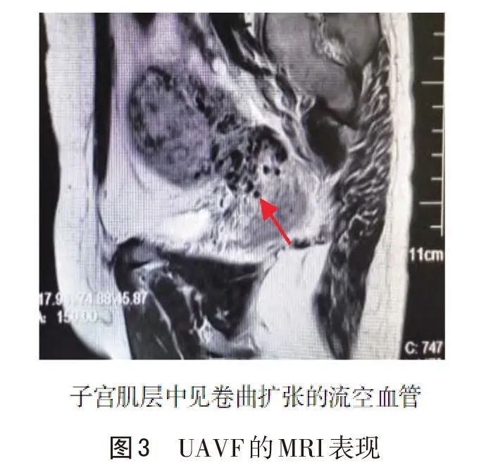 子宫动静脉瘘专家共识,子宫动静脉瘘诊断的金标准是什么