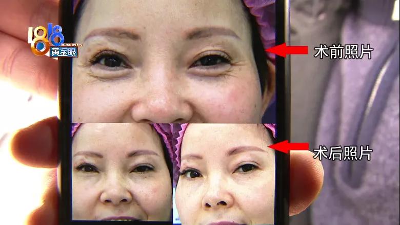 打了一次“少女眼”，提升效果不明显？