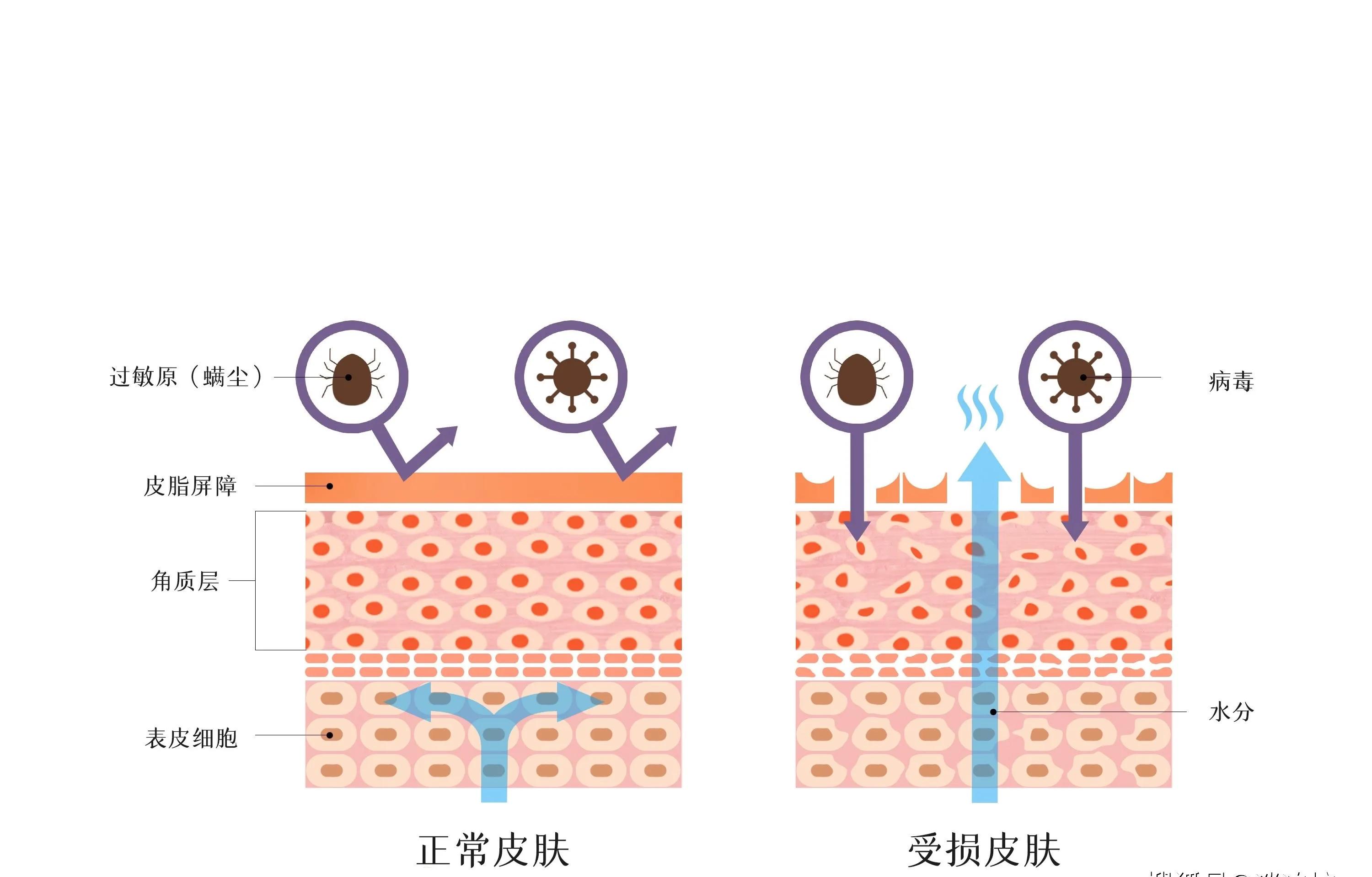 敏感性皮肤红血丝怎么护理,敏感皮肤薄有红血丝怎么办