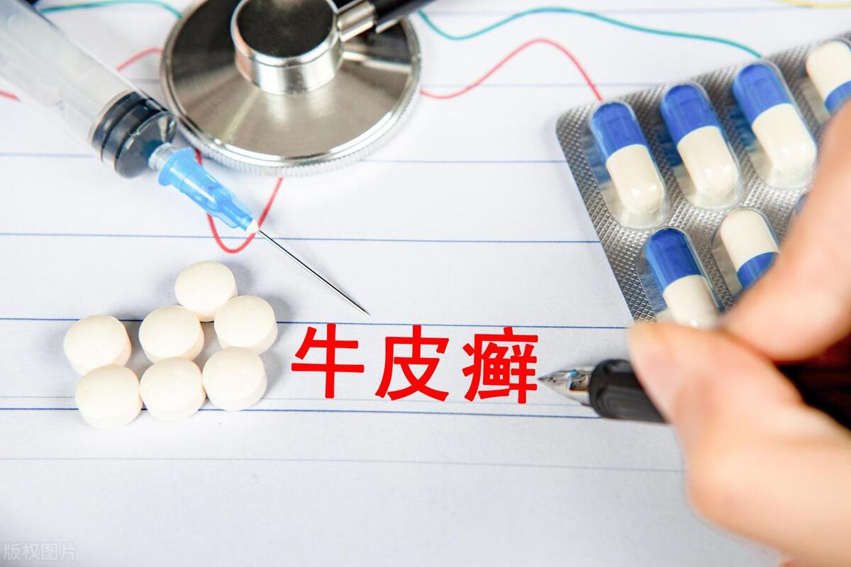 牛皮癣不是癣,牛皮癣不是癌症胜似癌症