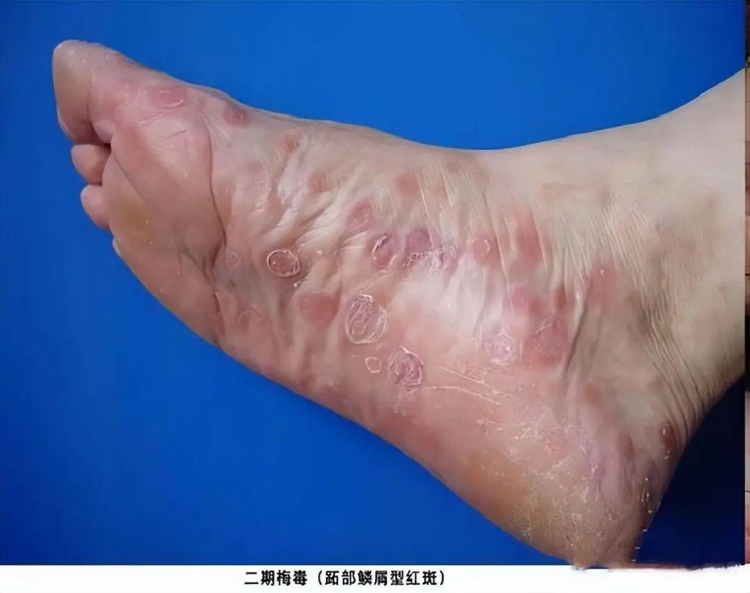 梅毒潜伏性,梅毒能在身体里潜伏几年没有症状